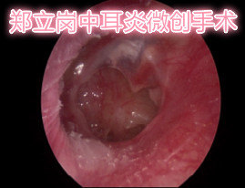 探索前沿：胆脂瘤微创手术新价格亮点